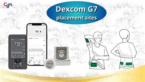 dexcom g7 sensor placement sites